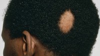 Alopecia